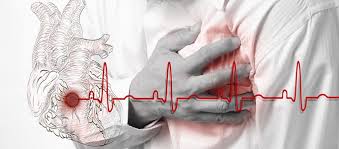 Chest Pain: Symptomatic approach: GP Guideline by Platform