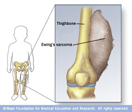 দেশে প্রথম ‘ইউইংস সারকোমা’ (Ewing’s Sarcoma) সফল অস্ত্রোপচার