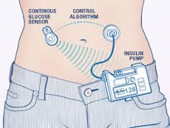 Artificial Pancreas : কৃত্রিম অগ্ন্যাশয় স্থাপিত হল মানব দেহে