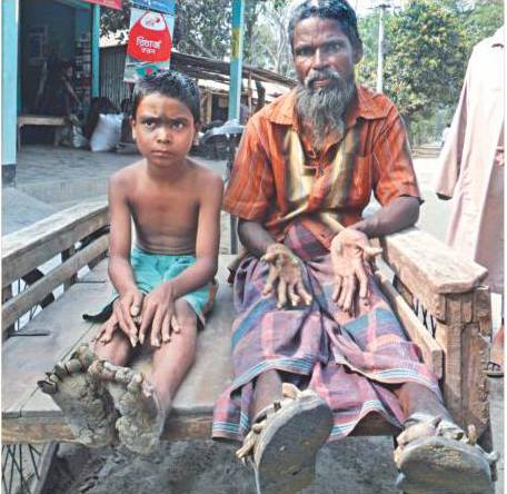 দূর্লোভ চর্মরোগে আক্রান্ত বাবা ও ছেলে আজ ঢাকা মেডিকেলে ভর্তি হয়েছে