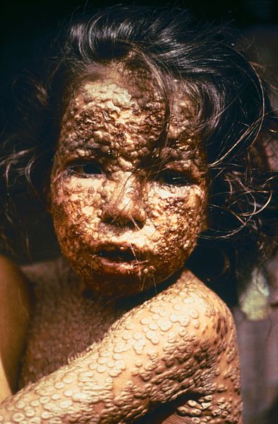 Small Pox Girl