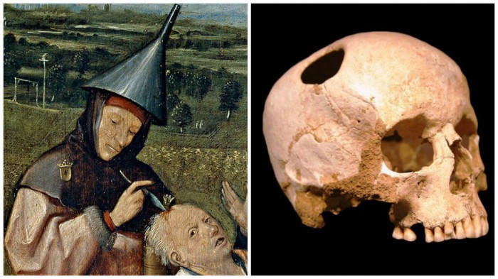 ancient-trepanation-1