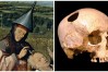 ancient-trepanation-1
