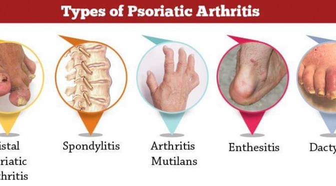 সোরিয়াটিক আর্থ্রাইটিস নিয়ে কিছু কথা