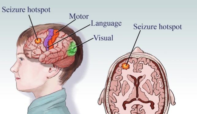 সিজার_এপিলেপ্সি