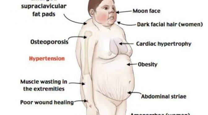 Basic Concept Of Cushing’s Syndrome