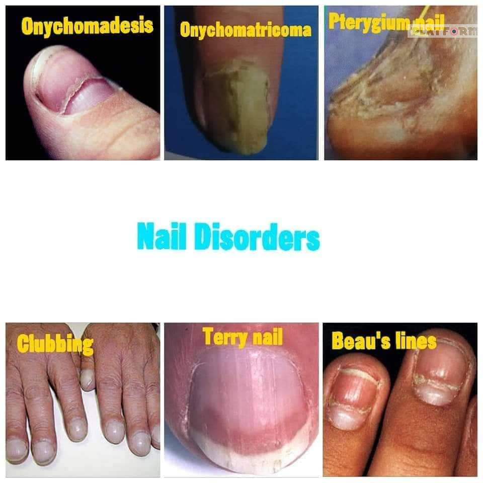 Nail Disorders: A Medical Dictionary