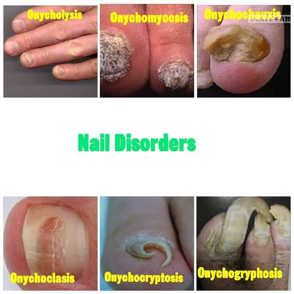 Nail Disorders: A Medical Dictionary