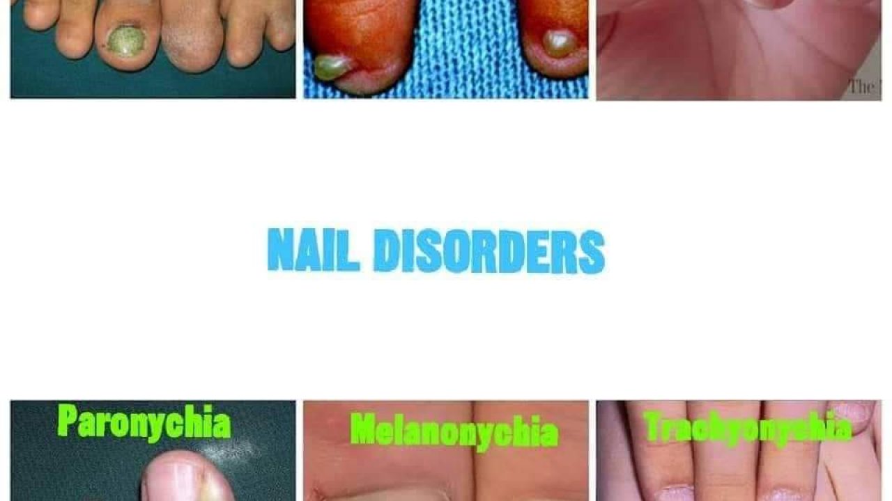 Nail Disorders: A Medical Dictionary Nail Disorders: A Medical Dictionary