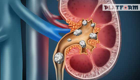 ডা. শুভাগত চৌধুরীর স্বাস্থ্যবার্তা: কীভাবে রোধ করা যায় কিডনির পাথর