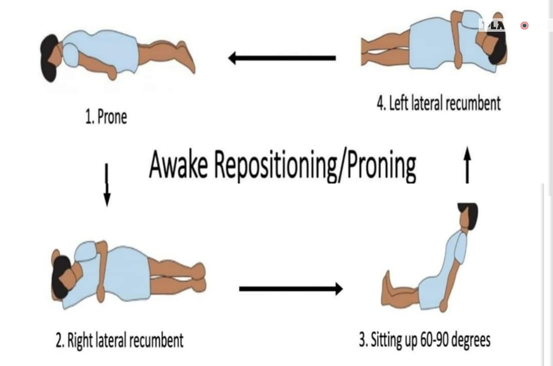 করোনার একটি অবহেলিত চিকিৎসা পদ্ধতি “Awake Proning”