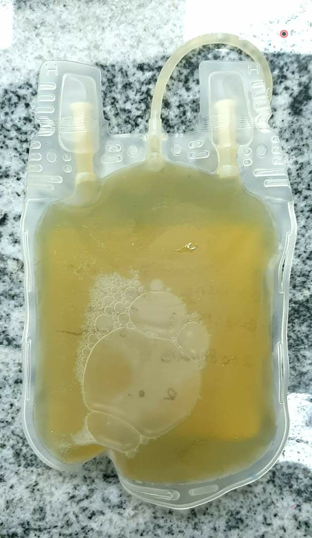 সবুজাভ প্লাজমা ফেলে দেওয়া কি উচিত?